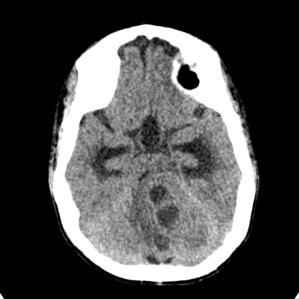 Cerebellar abscess secondary to mastoiditis (Radiopaedia 26284-26412 Axial non-contrast 55).jpg