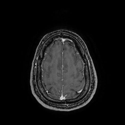 Cerebellar hemangioblastoma (Radiopaedia 88055-104622 Axial T1 C+ 145).jpg