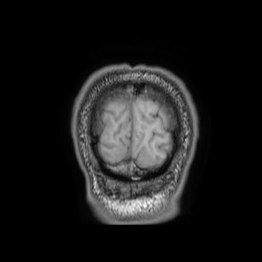 File:Cerebellar hemangioblastoma (Radiopaedia 88055-104622 Coronal T1 35).jpg