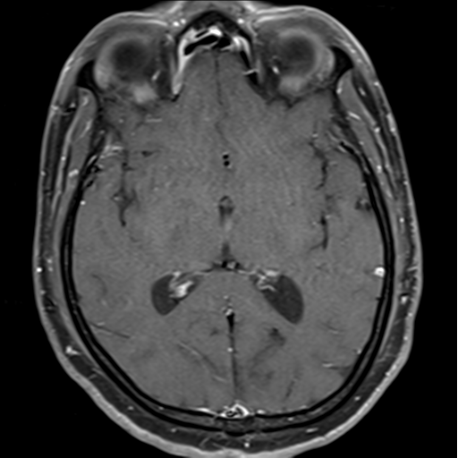 File:Cerebellar hemangioblastomas and pituitary adenoma (Radiopaedia 85490-101176 Axial T1 C+ fat sat 22).png