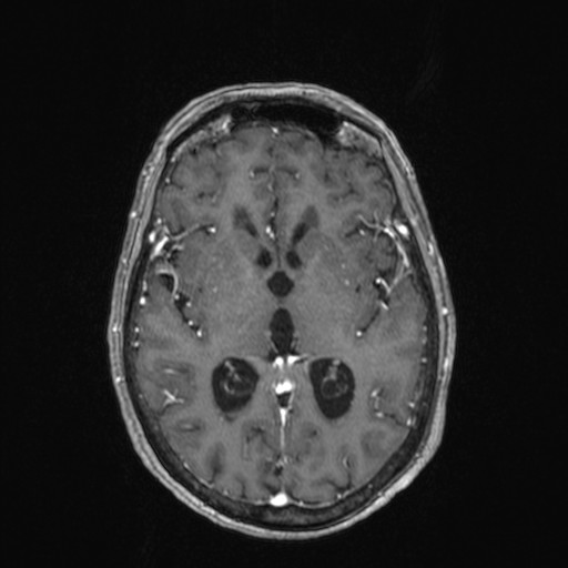 Cerebellar metastases (Radiopaedia 24038-24249 Axial T1 C+ 14).jpg