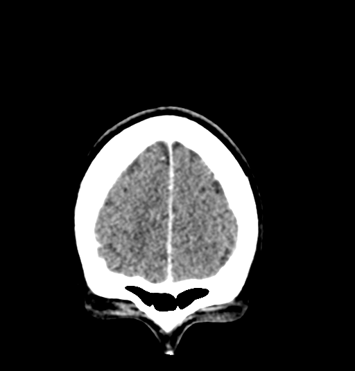 Cerebellar metastases - colorectal adenocarcinoma (Radiopaedia 40947-43652 Coronal C+ 15).png