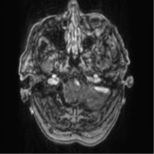 Cerebellar metastasis from lung adenocarcinoma (Radiopaedia 86690-102829 Axial T1 C+ 13).png