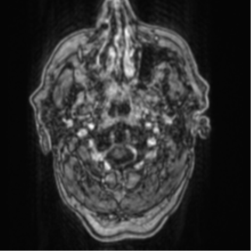 Cerebellar metastasis from lung adenocarcinoma (Radiopaedia 86690-102829 Axial T1 C+ 3).png