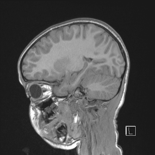 File:Cerebellar stroke (Radiopaedia 32202-33150 Sagittal T1 C+ 35).png