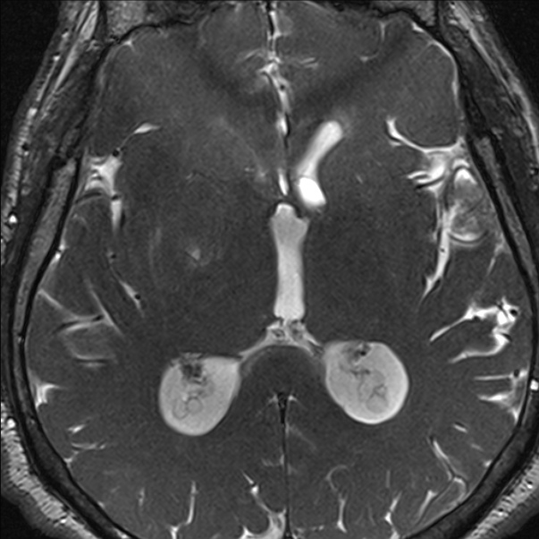 Cerebellopontine angle meningioma (Radiopaedia 24459-24764 I 56).jpg
