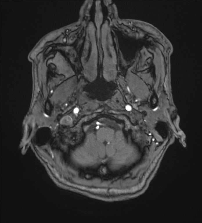 Cerebellopontine angle meningioma (Radiopaedia 72983-83680 Axial MRA 4).jpg