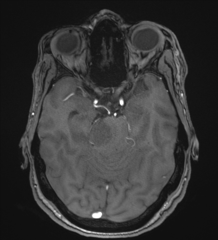 Cerebellopontine angle meningioma (Radiopaedia 72983-83680 Axial MRA 44).jpg