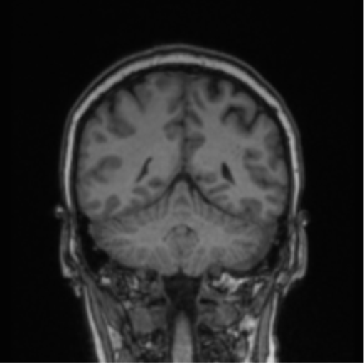 File:Cerebral abscess from pulmonary arteriovenous malformation (Radiopaedia 86275-102291 Coronal T1 31).png
