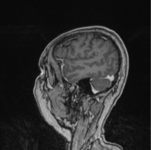 Cerebral abscess from pulmonary arteriovenous malformation (Radiopaedia 86275-102291 Sagittal T1 C+ 16).png
