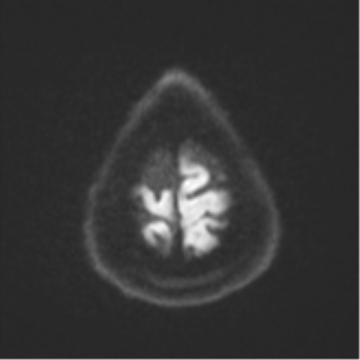 Cerebral abscesses- medically managed (Radiopaedia 45183-49179 Axial DWI 54).png