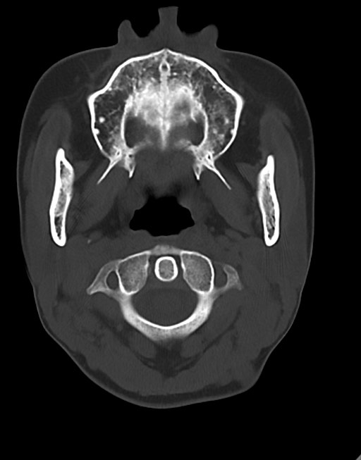 Cerebral abscesses (Radiopaedia 70458-80568 Axial bone window 6).jpg