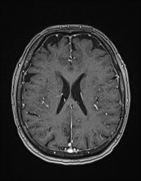 Cerebral amyloid angiopathy-related inflammation (Radiopaedia 58270-65377 Axial T1 C+ fat sat 91).jpg