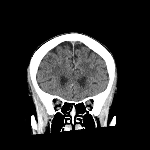 Cerebral amyloid angiopathy-related inflammation (Radiopaedia 74836-85848 Coronal non-contrast 22).jpg