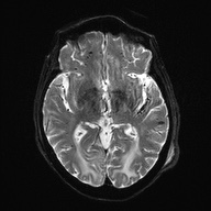 Cerebral amyloid angiopathy-related inflammation (Radiopaedia 74836-85849 Axial DWI 15).jpg