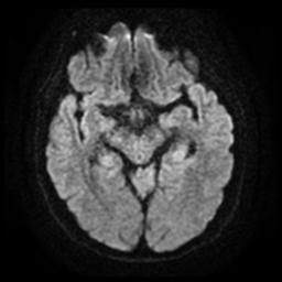 Cerebral amyloid angiopathy (Radiopaedia 28698-28978 Axial DWI 12).jpg