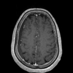Cerebral amyloid angiopathy (Radiopaedia 29129-29518 Axial T1 C+ 111).jpg