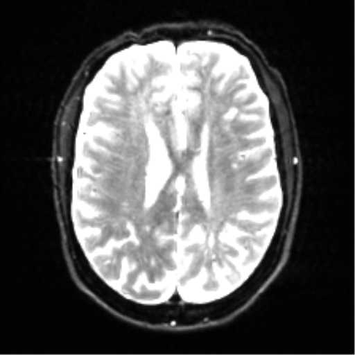 Cerebral amyloid angiopathy (Radiopaedia 46082-50433 Axial DWI 17).png
