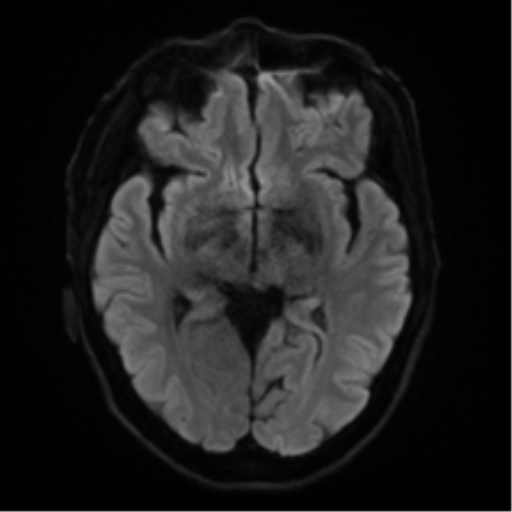 Cerebral amyloid angiopathy (Radiopaedia 46082-50433 Axial DWI 39).png
