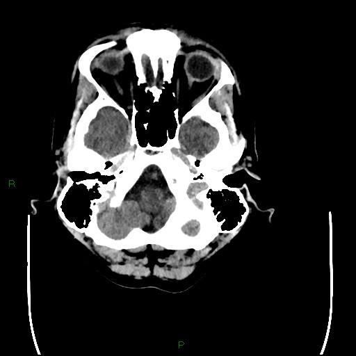 Cerebral amyloid angiopathy (Radiopaedia 77506-89665 Axial non-contrast 17).jpg