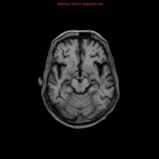File:Cerebral and orbital tuberculomas (Radiopaedia 13308-13311 Axial T1 9).jpg