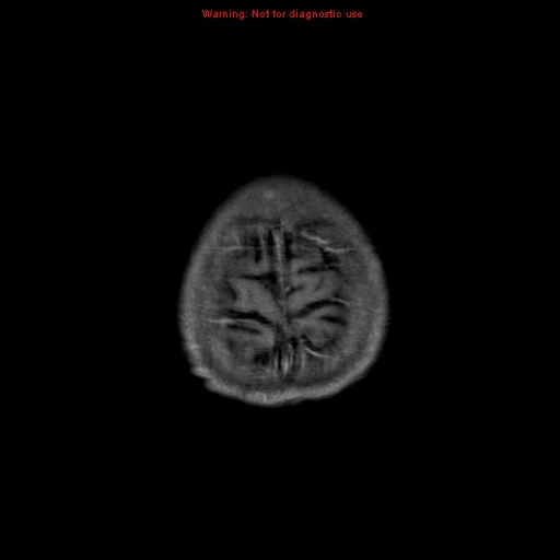 File:Cerebral and orbital tuberculomas (Radiopaedia 13308-13311 Axial T1 C+ 20).jpg