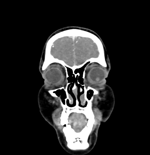 Cerebral arteriovenous malformation (Radiopaedia 73830-84645 C 12).jpg