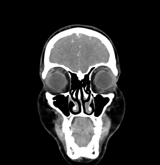 Cerebral arteriovenous malformation (Radiopaedia 73830-84645 C 15).jpg