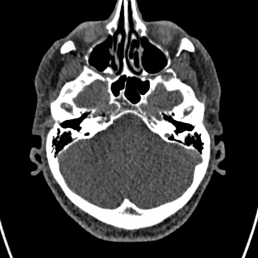 Cerebral arteriovenous malformation (Radiopaedia 78188-90746 Axial non-contrast 40).jpg