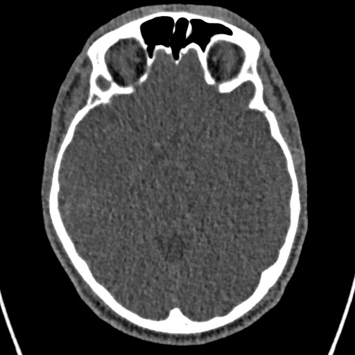 File:Cerebral arteriovenous malformation (Radiopaedia 78188-90746 Axial non-contrast 72).jpg