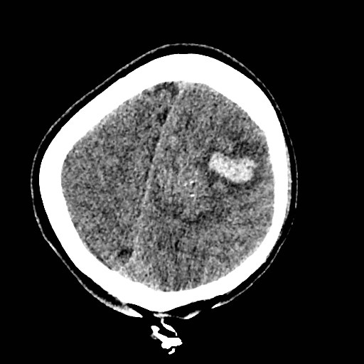 Cerebral arteriovenous malformation (Radiopaedia 79677-92887 Axial non-contrast 40).jpg
