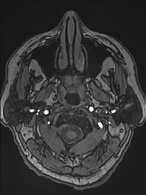 Cerebral arteriovenous malformation (Radiopaedia 84015-99245 Axial TOF 16).jpg