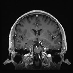 Cerebral arteriovenous malformation (Radiopaedia 84015-99245 Coronal T1 C+ 75).jpg