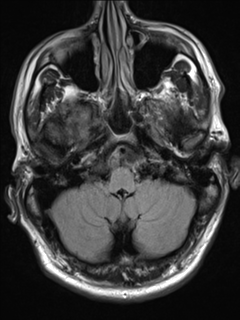 File:Cerebral arteriovenous malformation - huge (Radiopaedia 35734-37272 Axial FLAIR 4).png