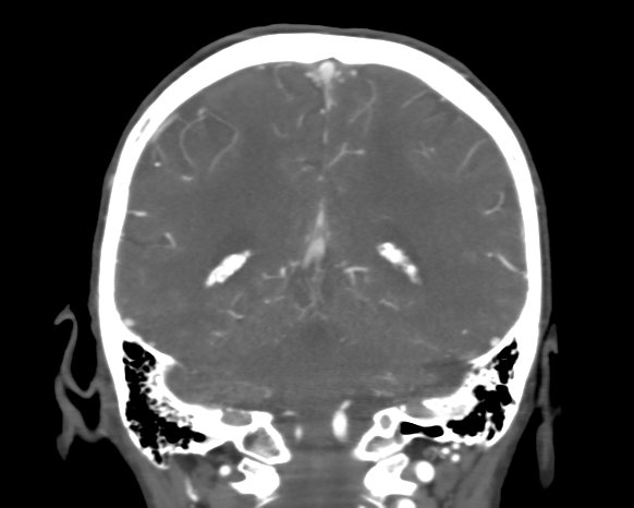 File:Cerebral arteriovenous malformation with lobar hemorrhage (Radiopaedia 44725-48511 A 40).png