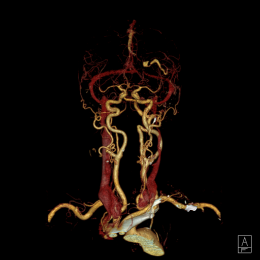 File:Cerebral arteriovenous malformation with lobar hemorrhage (Radiopaedia 44725-48512 3D VRT 2).png
