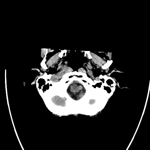File:Cerebral arteriovenous malformation with lobar hemorrhage (Radiopaedia 44725-48512 Axial non-contrast 8).png