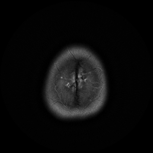 File:Cerebral autosomal dominant arteriopathy with subcortical infarcts and leukoencephalopathy (CADASIL) (Radiopaedia 41018-43768 Ax T2 PROP 20).png