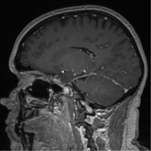 Cerebral cavernoma and development venous anomaly (Radiopaedia 37603-39482 Sagittal T1 C+ 57).png
