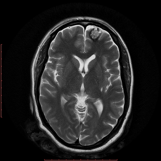 File:Cerebral cavernous malformation (Radiopaedia 26177-26306 Axial T2 11).jpg