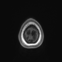 File:Cerebral cavernous venous malformation (Radiopaedia 70008-80021 Axial T1 93).jpg