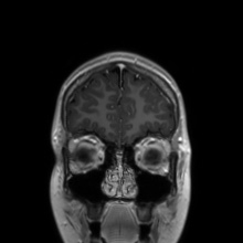 File:Cerebral cavernous venous malformation (Radiopaedia 70008-80021 Coronal T1 C+ 52).jpg