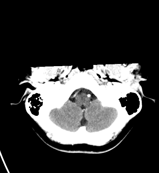 File:Cerebral cavernous venous malformations (Radiopaedia 48117-52945 Axial C+ delayed 7).png