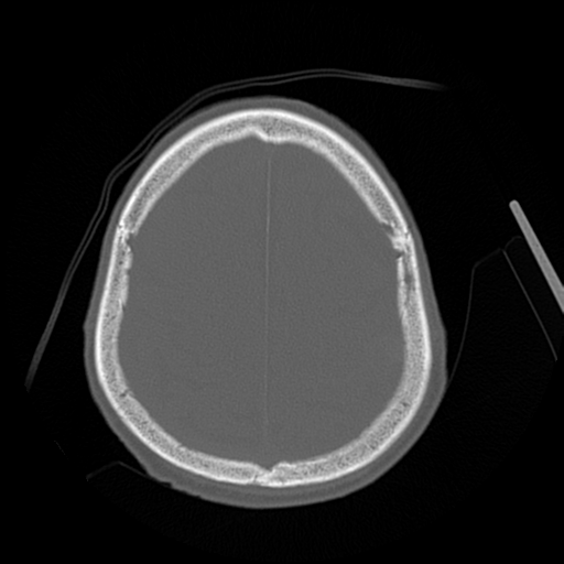 File:Cerebral contusions, subarachnoid hemorrhage and subdural hygromas (Radiopaedia 55399-61827 Axial bone window 41).png