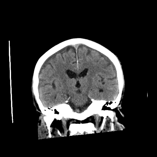 File:Cerebral contusions, subarachnoid hemorrhage and subdural hygromas (Radiopaedia 55399-61828 Axial non-contrast 1).png