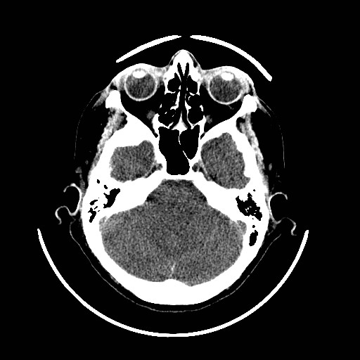 File:Cerebral edema (evolution in time) (Radiopaedia 19418-19439 non-contrast 28).jpg