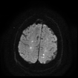 Cerebral embolic infarcts (embolic shower) (Radiopaedia 49837-55108 Axial DWI 59).jpg