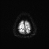 Cerebral embolic infarcts (embolic shower) (Radiopaedia 72391-82921 Axial DWI 29).jpg