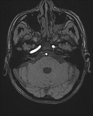 Cerebral embolic infarcts (embolic shower) (Radiopaedia 72391-82921 Axial MRA 26).jpg