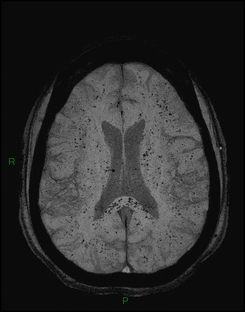Cerebral fat embolism (Radiopaedia 35022-36525 Axial SWI 28).jpg